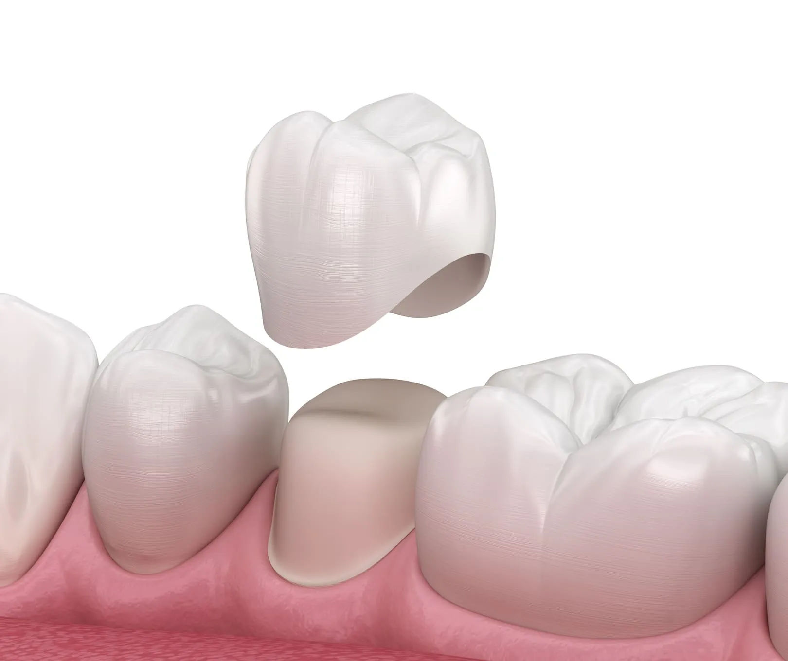 Digital illustration of a dental crown being placed over a prepared tooth among natural teeth.